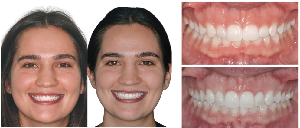 Providence Pediatric Dentistry and Orthodontics teeth progress picture